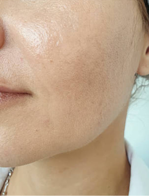 mesotherapy 1 before