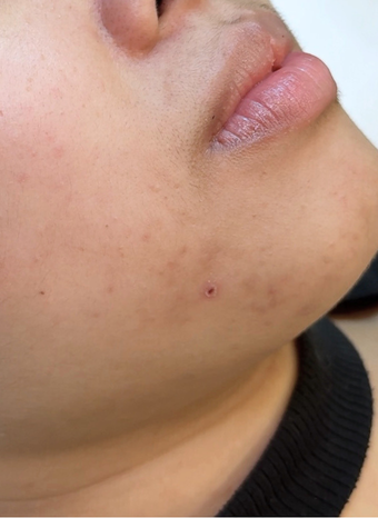 microbiome facial 1 after