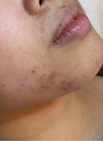 microbiome facial 1 before