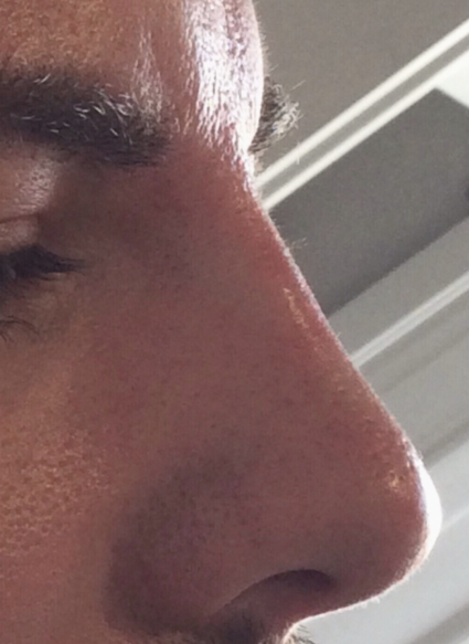 non surgical rhinoplasty 1 after