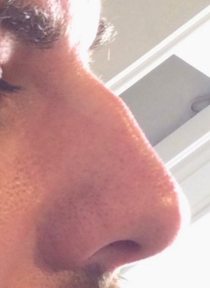 non surgical rhinoplasty 1 before