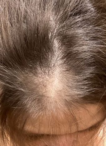 platelet rich plasma prp for hair loss 1 after