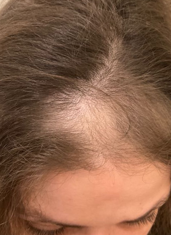 platelet rich plasma prp for hair loss 1 before