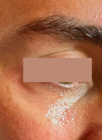 tear trough filler 1 before