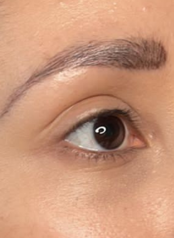 tear trough filler 2 after