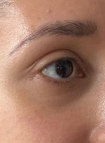 tear trough filler 2 before