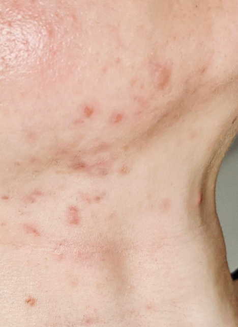 theraclear acne therapy 1 after