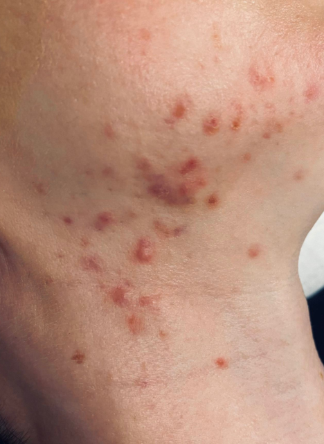 theraclear acne therapy 1 before
