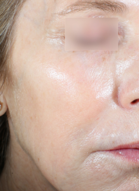 ultraclear fractional 3dmiracl 1 after