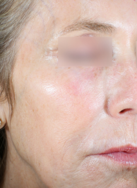 ultraclear fractional 3dmiracl 1 before