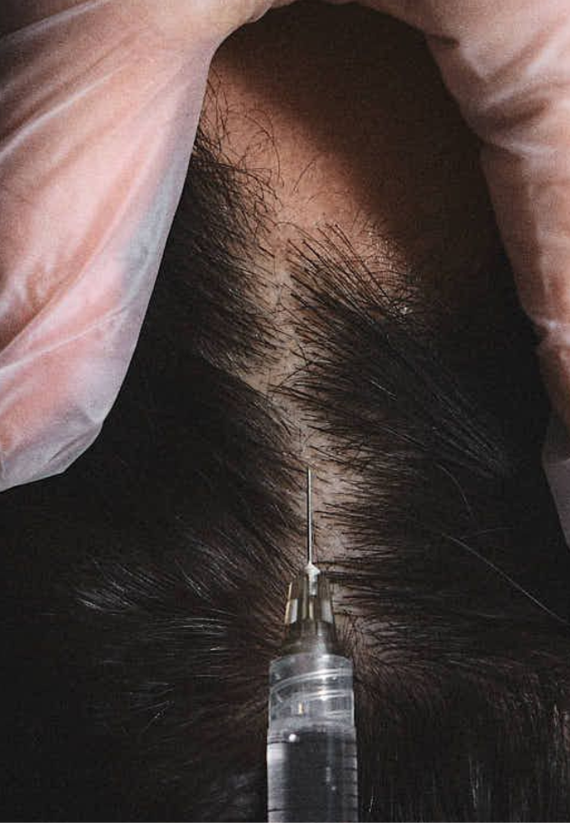PRP For Hair Loss